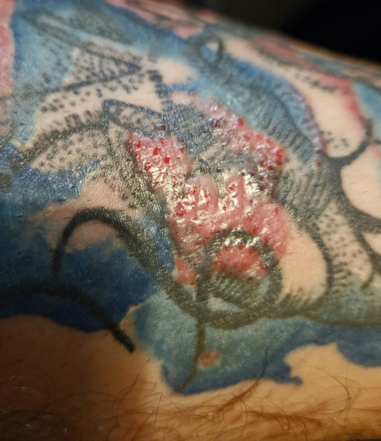 red_tattoo_allergy (2)
